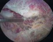 Minimally Invasive Treatment for Scapulothoracic Disorders