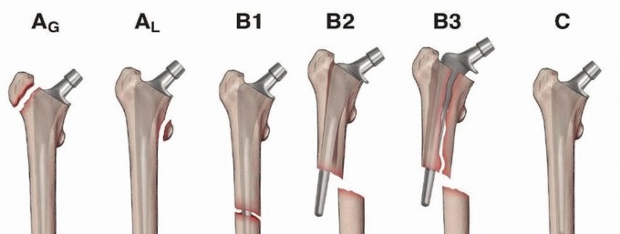 Mastering Fixation of Periprosthetic Fractures of the Femur