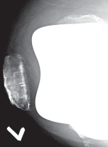 Illustration 3 for The Principles of Revision TKR: Avoid Pitfalls, Ensure Success