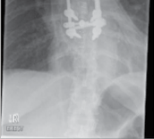 Illustration 11 for Mastering Thoracolumbar Surgery: Full Operative Planning