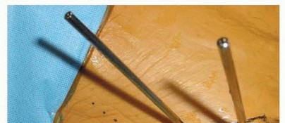 Illustration 20 for Emergency Fixation of the Pelvis: Control Bleeding & Restore Stability