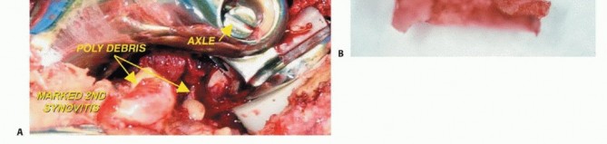 Illustration 87 for Advanced Distal Femoral Resections: Limb-Sparing Outcomes & Techniques