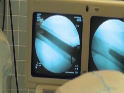 Illustration 41 for THA for patients with proximal femoral deformity: Practical solutions