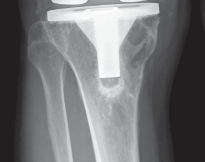 Illustration 3 for Porous Metal Cones: Biologic Fixation for Severe Bone Loss
