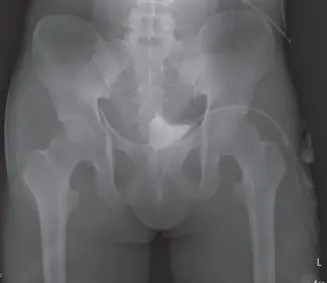 خلع الورك الرضحي: دليل شامل للمريض مع الأستاذ الدكتور محمد هطيف في صنعاء