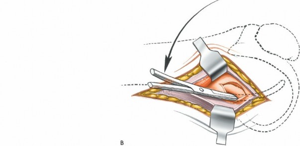 Illustration 231 for Mastering Knee Approaches: Spotlight on Superficial Medial Ligament