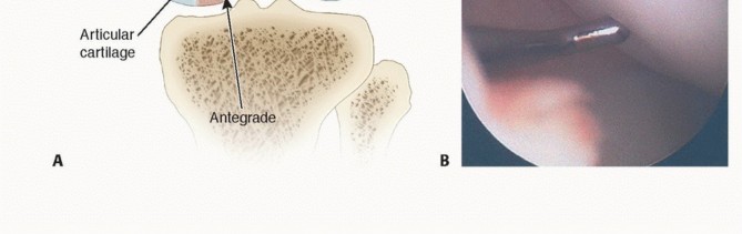 Illustration 27 for Dissecans of the Knee: What's the Difference – OCD vs. AVN?