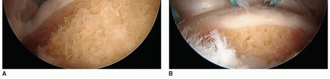 Illustration 5 for Hip Pain Relief: Arthroscopy for Nonstructural Pathology