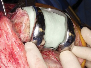 Illustration 32 for PROSTALAC Articulating Spacer: Treat Infected Knees, Regain Mobility