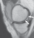 Illustration 7 for Microfracture Chondroplasty: How Tiny Holes Are Made to Fix Cartilage