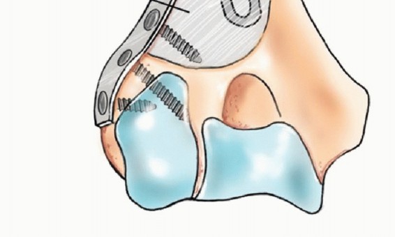 Illustration 43 for Restore Vital Function: Surgery for Type II Humeral Metastasis