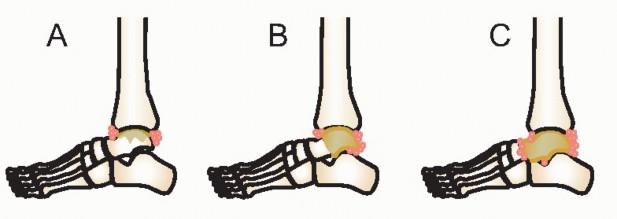 Beyond Amputation: Circular Fixation for Infection of the Talus