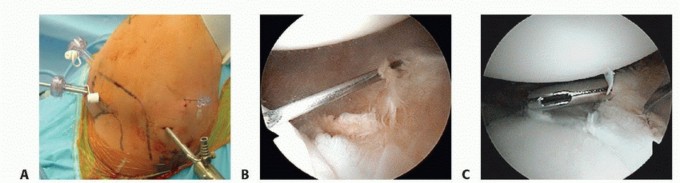 Illustration 28 for Regain Stability: Arthroscopy for Anterior Instability & the Inferior Glenohumeral Ligament