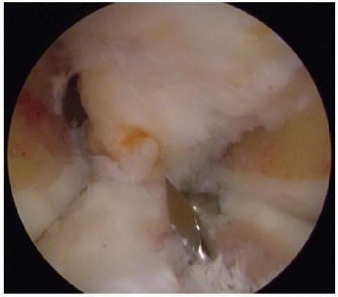 Illustration 32 for Symptomatic Knee? Meniscal Transplant for Anterior & Posterior Horns