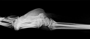 صورة طبية: دليل الأستاذ الدكتور محمد هطيف الشامل لأمراض وإصابات اليد والمعصم في صنعاء