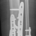 Illustration 26 for Decoding Pilon Fractures: Anterolateral and Medial Fragments Revealed