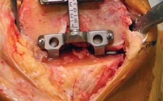 صورة طبية: استبدال مفصل الركبة بالحد الأدنى من التدخل الجراحي: ألم أقل وتعافٍ أسرع مع النهج شبه الرضفي الإنسي