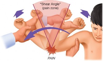 Illustration 3 for Pinpointing Collateral Ligament Instability in Elbow Injuries