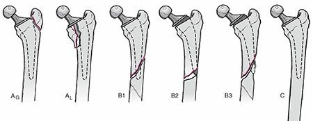 Illustration 4 for Periprosthetic Fractures: Causes, Risks, & Effective Treatment
