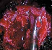 Illustration 20 for Mastering Anterior Interbody Arthrodesis with Instrumentation for Scoliosis