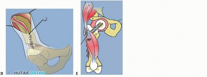Illustration 29 for Treatment for Congenital Femoral Deficiency: What You Need to Know