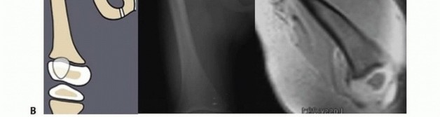 Illustration 6 for Treatment for Congenital Femoral Deficiency: What You Need to Know