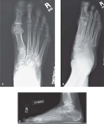 الدليل الشامل لعدم استقرار مفصل المشط السلامي الثاني: الأسباب، التشخيص، والعلاج المتطور