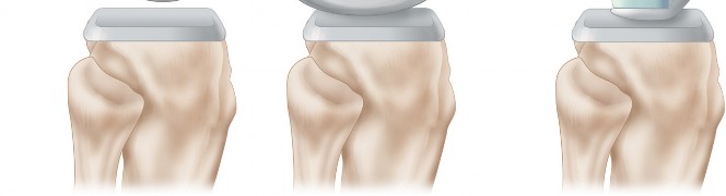 Illustration 20 for Understand Augments: The Role of Metal Augments in Arthroplasty