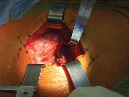 Illustration 53 for Successful Total Hip Replacement in Developmental Dysplasia