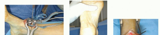 Illustration 15 for HINTEGRA Total Ankle: Unlocking Natural Ankle Movement