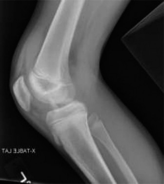 Illustration 2 for Tibial Eminence Fracture: Case 36 Diagnosis & Surgical Insights