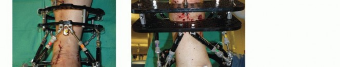 Illustration 51 for Optimize Pain Management with Proximal Ring Block for Ankle Arthrodesis