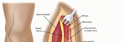 Illustration 58 for Surgical Approaches to Shoulder & Elbow: Pearls and Pitfalls