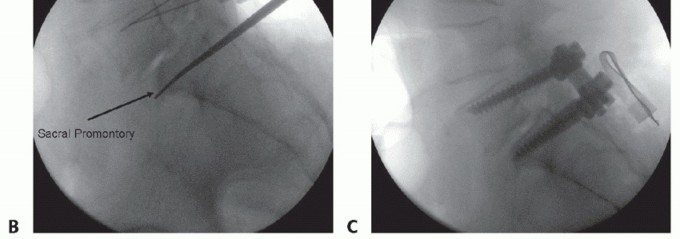Mastering Posterolateral Thoracolumbar Fusion with Instrumentation