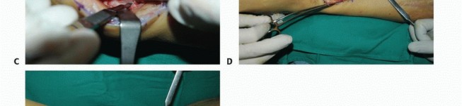 Illustration 45 for Foot Drop Surgery: How a Pin or Drill Elevates Tendon Transfer