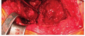 Illustration 19 for Uncemented Acetabular Revision: Optimizing Hemispherical Cup Use