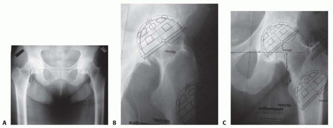 Illustration 2 for Cemented Total Hip: A Successful & Evidence-Based Solution