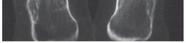 Illustration 5 for Beyond Amputation: Circular Fixation for Infection of the Talus