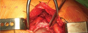 Illustration 89 for Successful Total Hip Replacement in Developmental Dysplasia