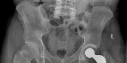 Illustration 8 for Advanced Bilateral Simultaneous THA: Uncemented Monobloc Case Title