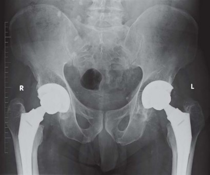 Illustration 67 for Kinectiv® Stem: Modular Necks for Primary THA Success