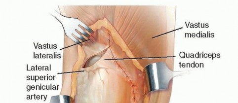 Illustration 3 for Master Extensile Exposure with V-Y Quadricepsplasty