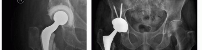 Illustration 11 for PJI of the Hip: Two-Stage Revision: When & How to Prepare