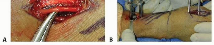 Illustration 23 for Effective K-Wire Fixation: Distal Radius Fractures Without External Fixation