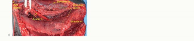 Illustration 10 for Optimizing Adductor Muscle Group Resection for Limb Preservation