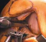 Illustration 11 for Knee Arthroplasty Unicondylar: Discover if Partial Knee Replacement is Right