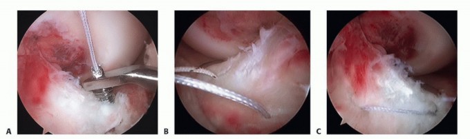Illustration 17 for Treating Tibial Spine Fractures: Arthroscopy or Open Reduction?