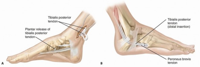 Illustration of tibialis posterior tendon - Dr. Mohammed Hutaif