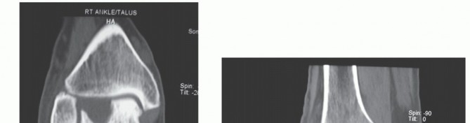 Illustration 9 for Unlock Stability: Medullary Nail Fixation for Tibiotalocalcaneal Arthrodesis