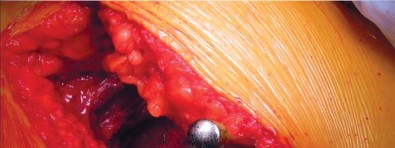 Illustration 22 for Unlock better THA: The technique of short stem for less invasiveness